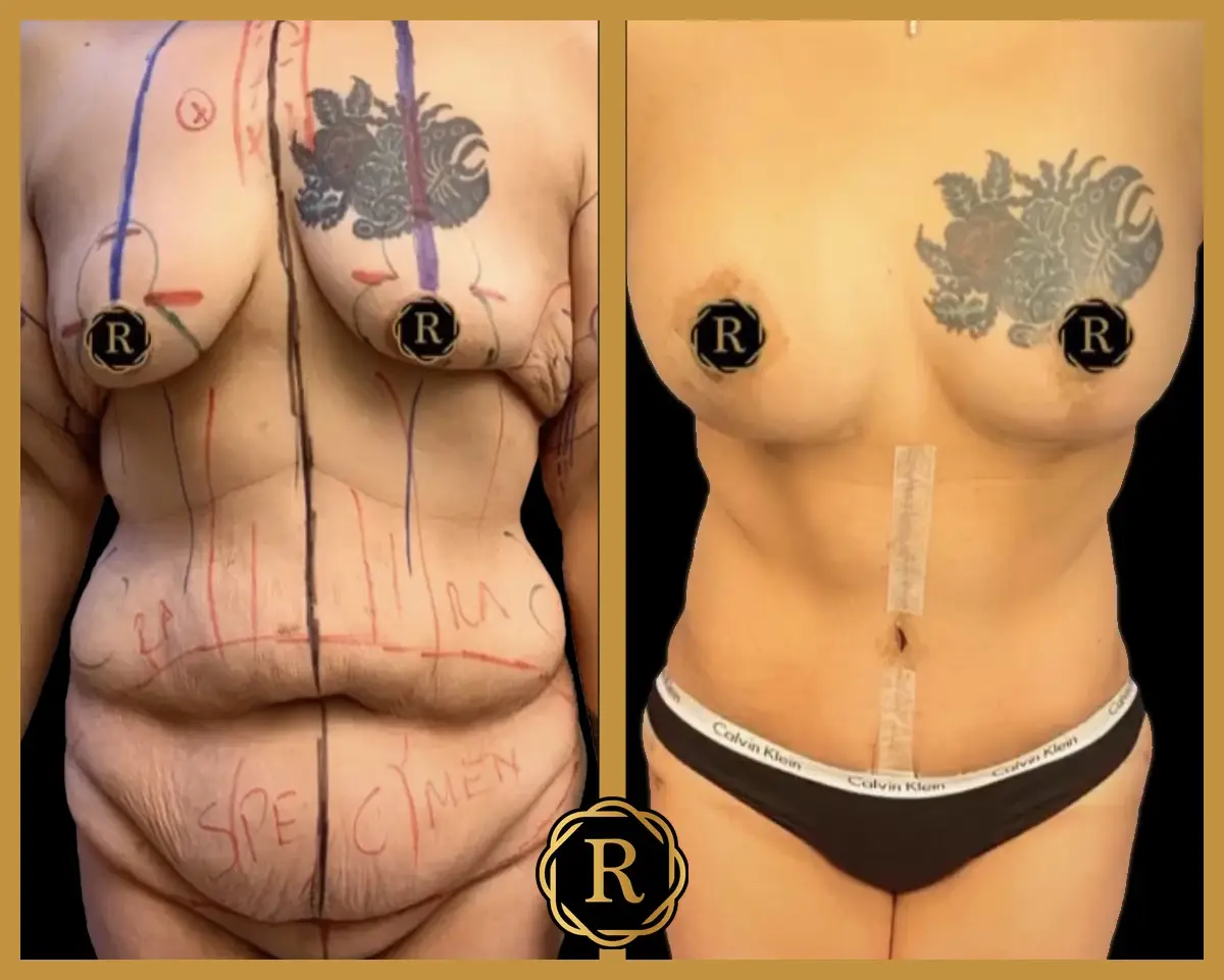 Mommy makeover before and after