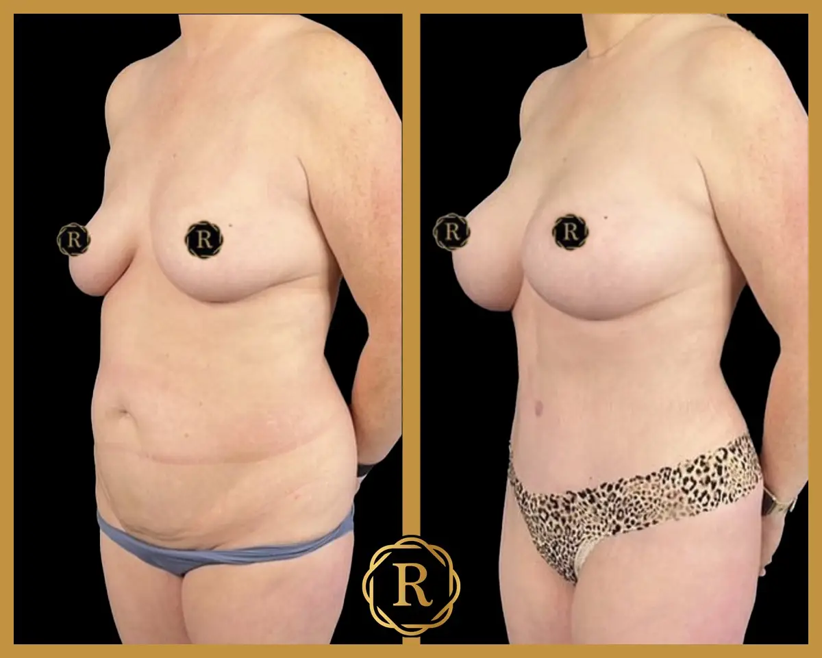 Mommy makeover before and after