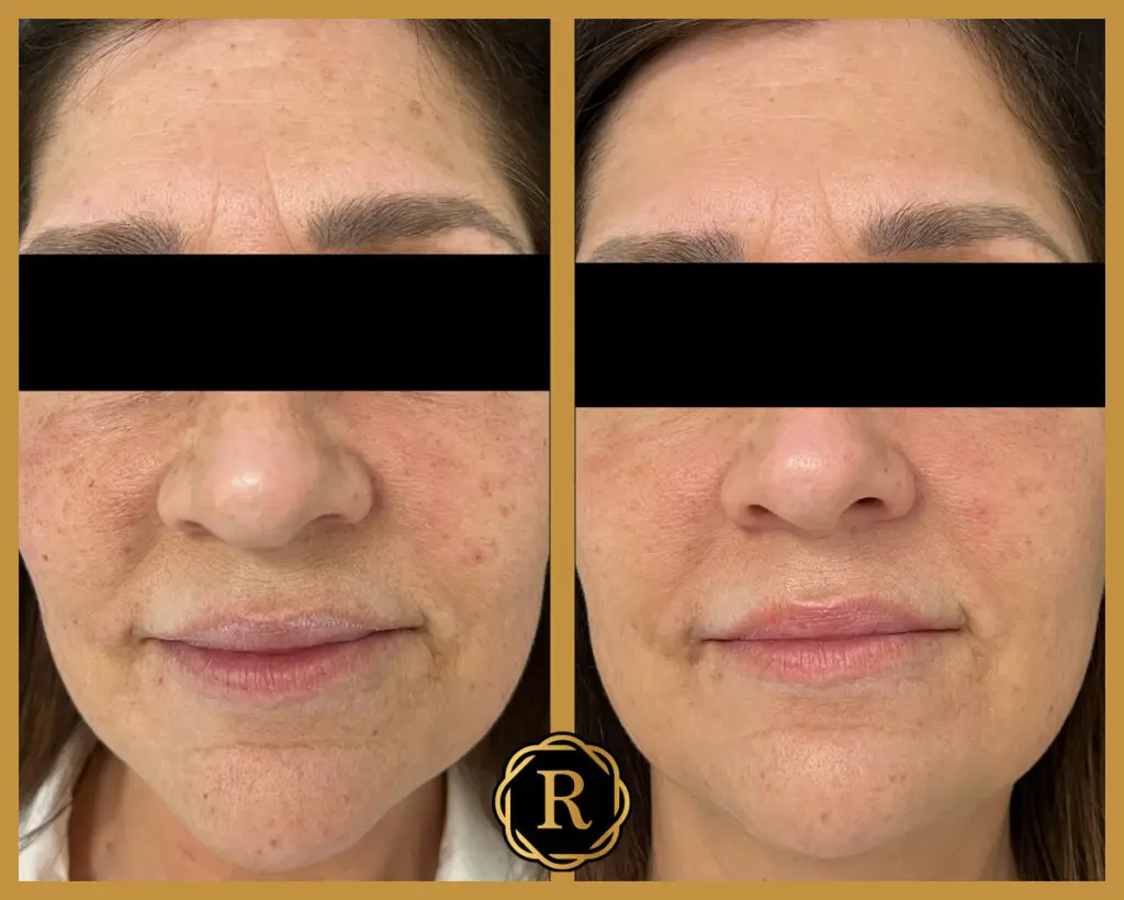 Moxi - Laser - Hero before and after BBL HERO™ Laser