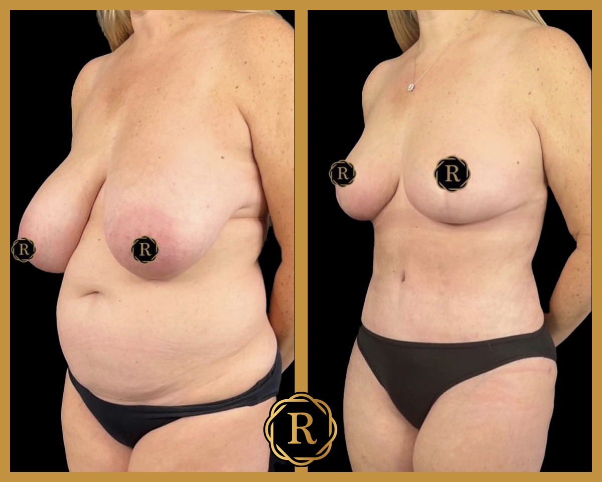 Breast reduction performed by Dr. Babis Rammos