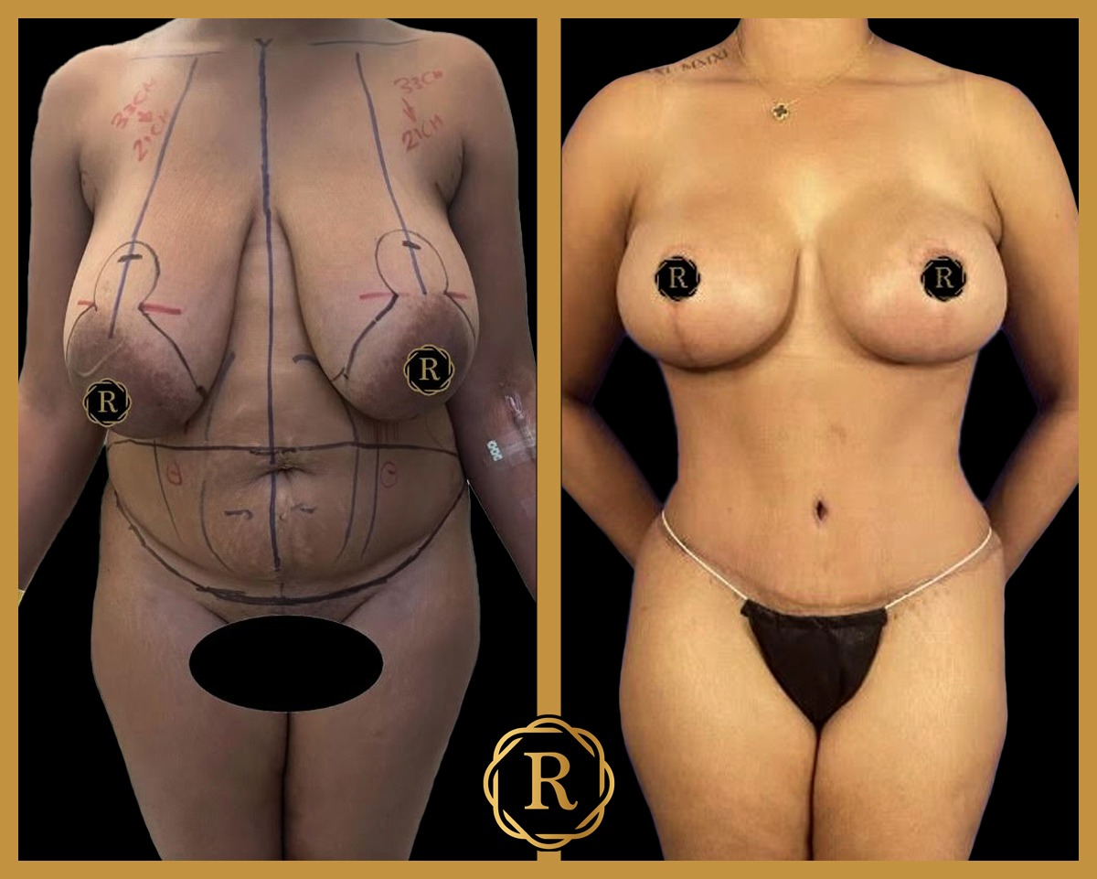 Breast lift/reduction performed by Dr. Babis Rammos