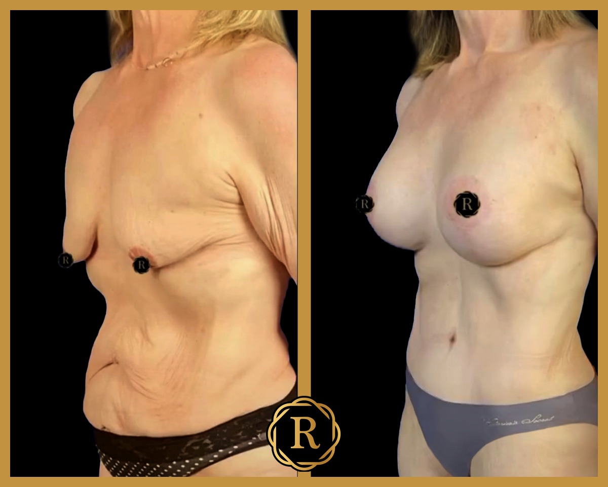 Breast lift with implant performed by Dr. Babis Rammos