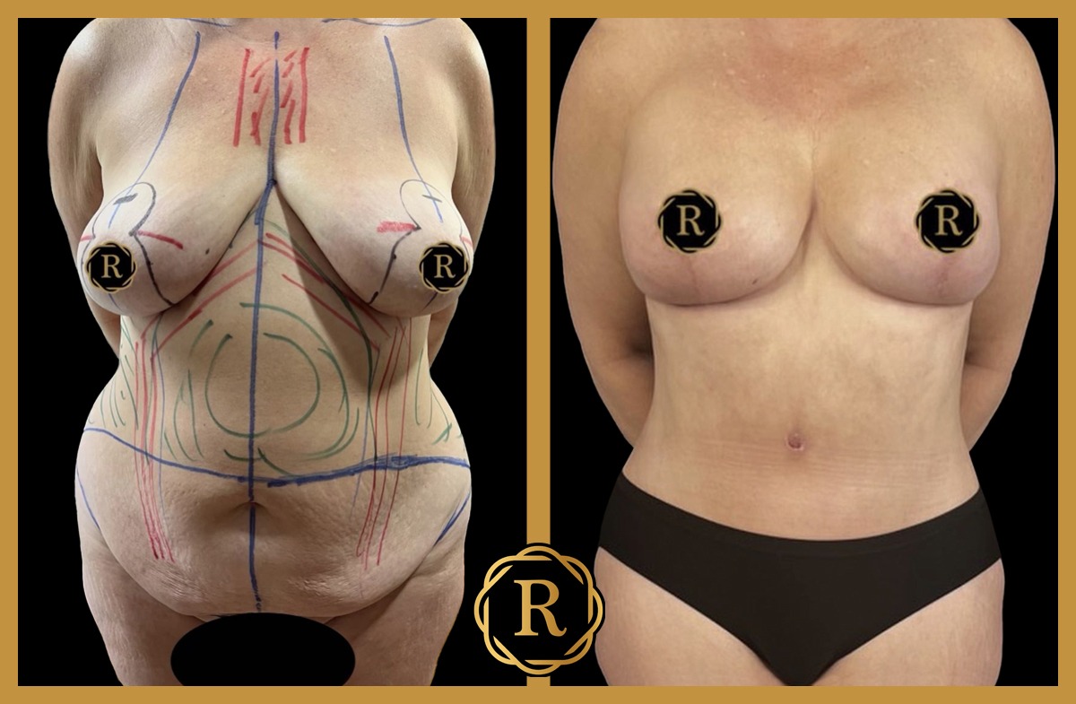 Breast Lift with Implant performed by Dr. Babis Rammos