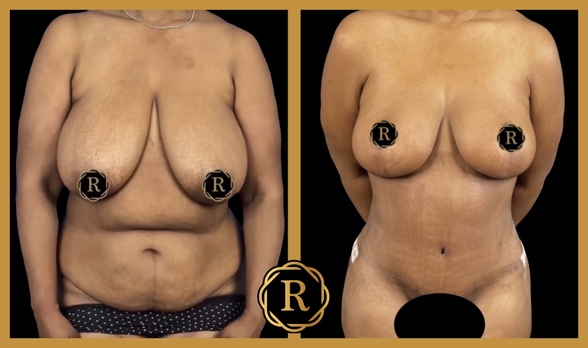 Lower Body Lift surgery performed by Dr. Rammos