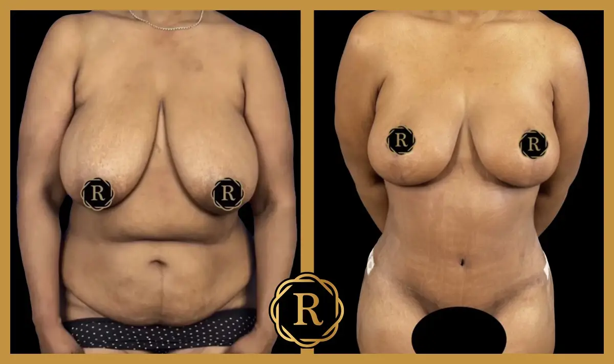Mommy makeover, surgery performed by Dr. Rammos