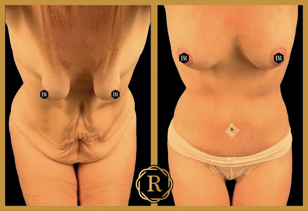 Mommy makeover, surgery performed by Dr. Rammos