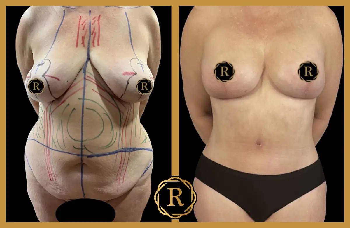 Mommy makeover, surgery performed by Dr. Rammos