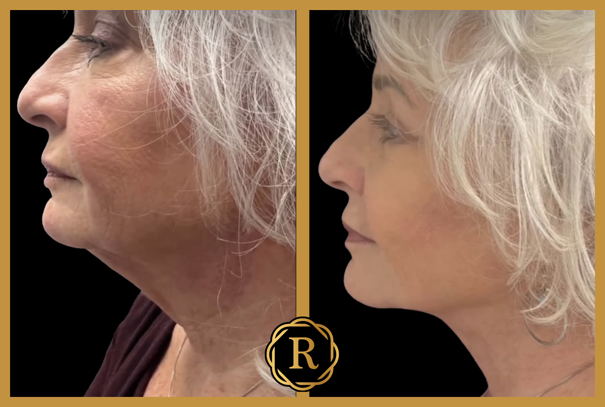 Facelift surgery performed by Dr. Rammos