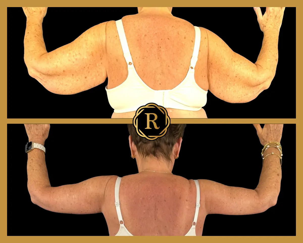 Arm Lift before and after