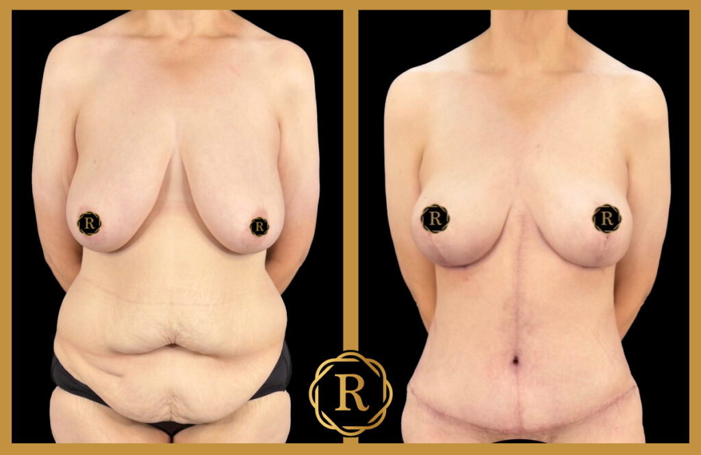 Procedures performed: Mommy Makeover, Tummy Tuck, Breast Lift, Breast Reduction