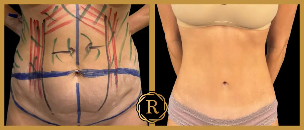 Procedures performed: Tummy Tuck
