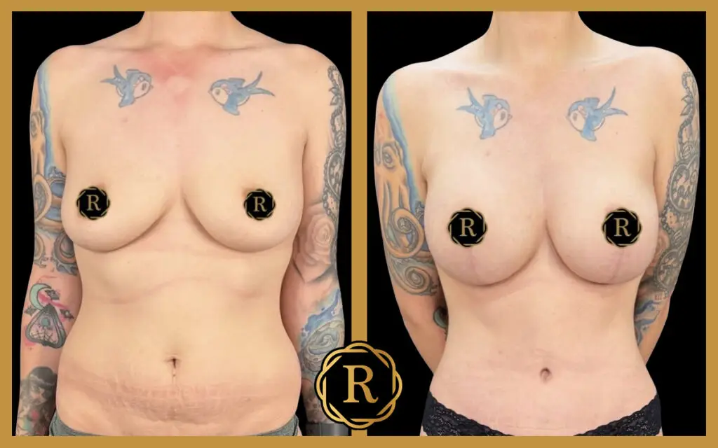 Procedures performed: Tummy Tuck, Mommy Makeover, Breast Lift with Implant