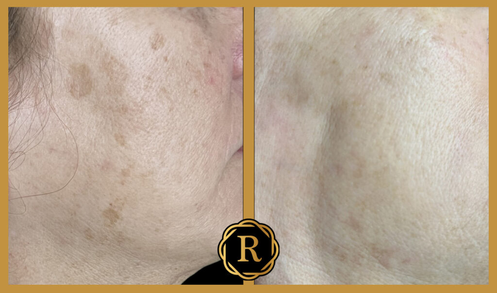 Female in her 60's treated with BBL Hero Laser for dark spots